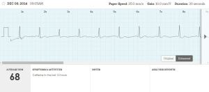 One of my AliveCor ECGs on the website