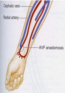Artery - vein fistula
