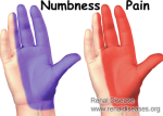 Numbness and pain